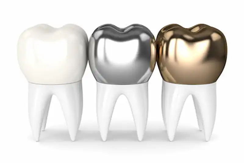 Dental-Crowns Restorative Dentistry Types of Crowns