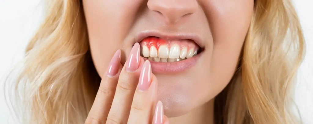 Periodontal Care showing woman's irritated gums