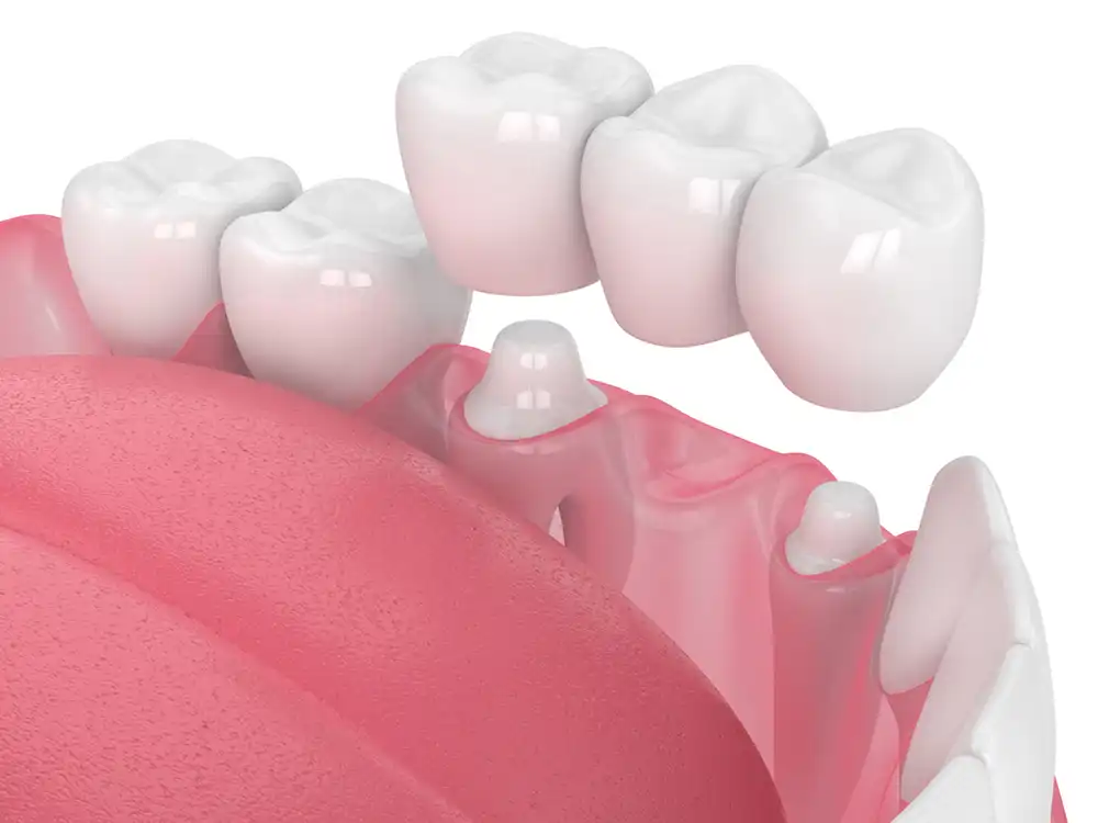 Implant and partial dentistry showing a bridge example