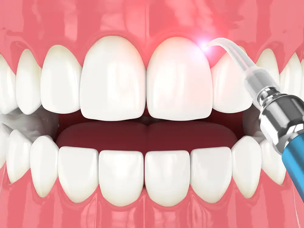 Dental Cleaning photo of removing plaque