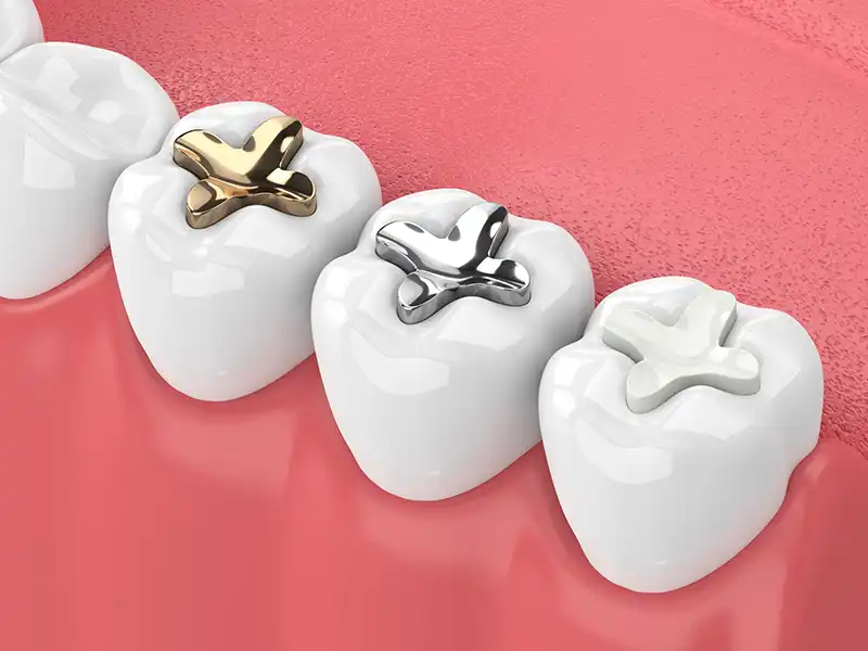 Dental Fillings Restorative Dentistry Filling Types