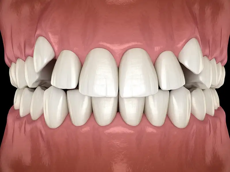 Crowding-teeth example