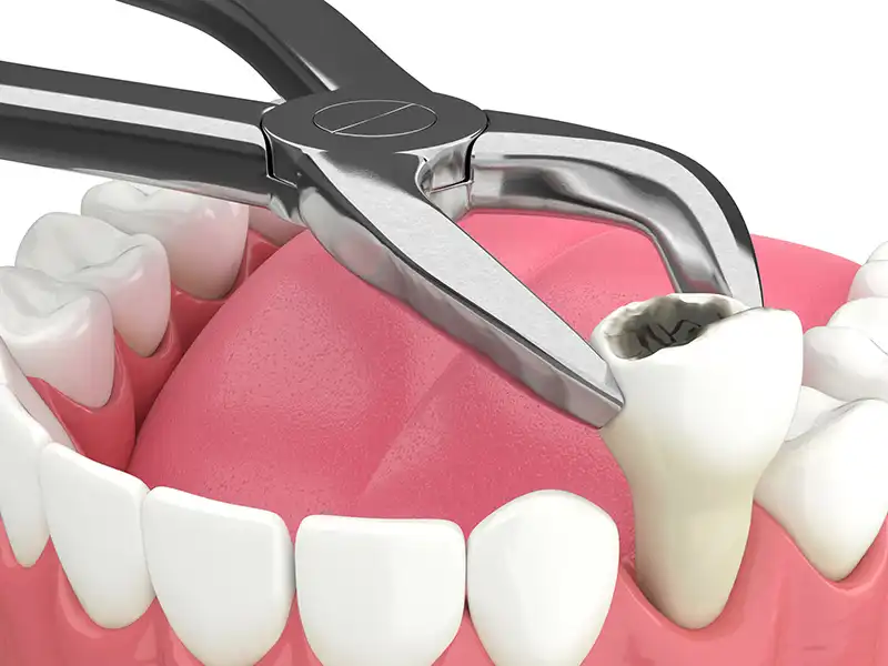 Extractions Restorative Dentistry Tooth Extraction Cavity