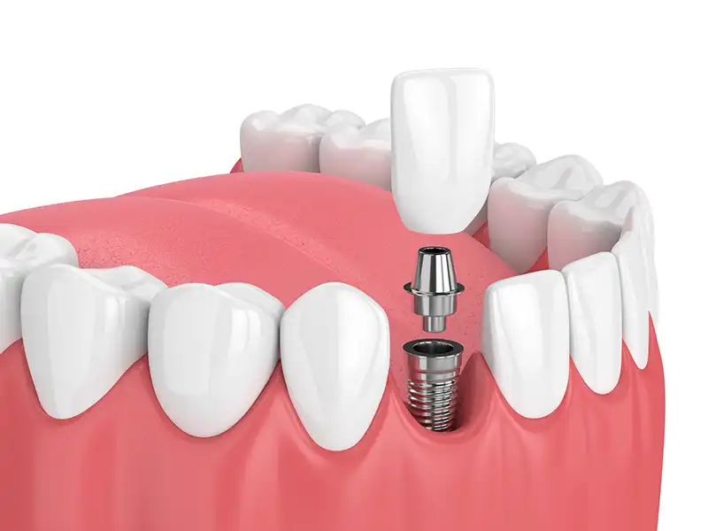 Dental Implants Dental Implants show the insertion process