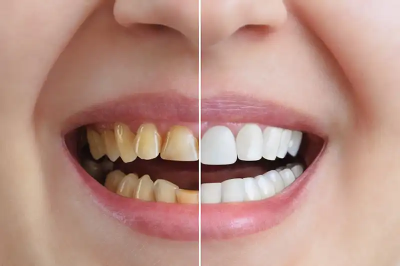 teeth-whitening Teeth Whitening showing before and after