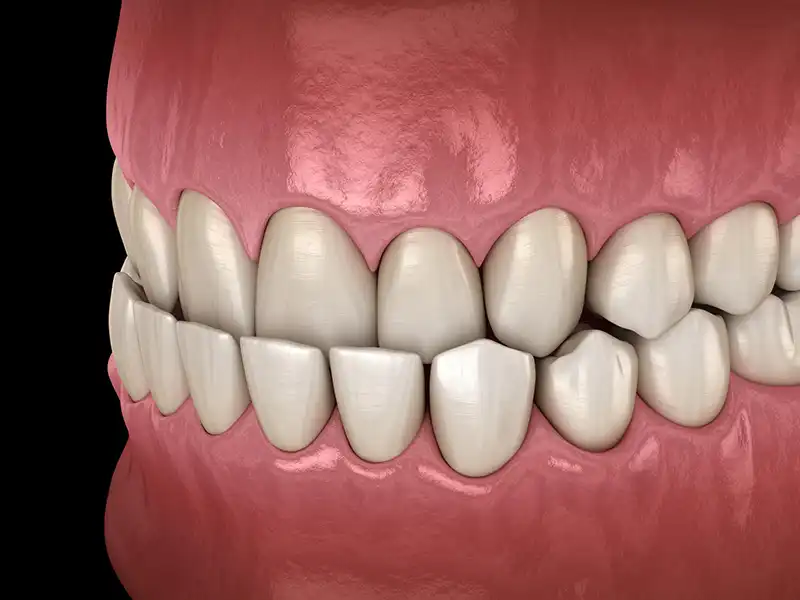underbite of teeth