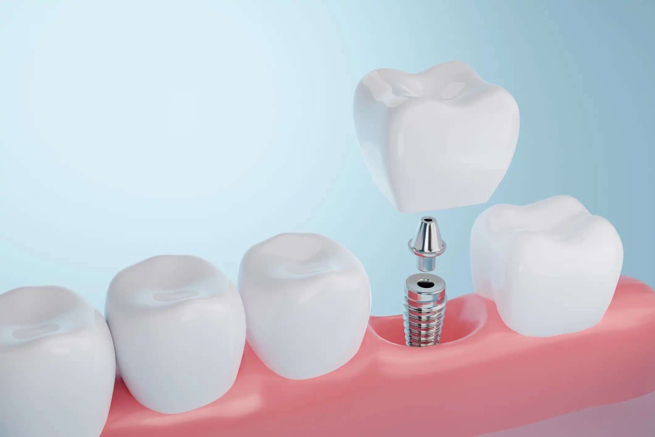 Dental Implant