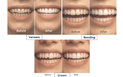 Cosmetic FAQ: What’s the Difference Between Veneers, Dental Bonding, and Crowns?